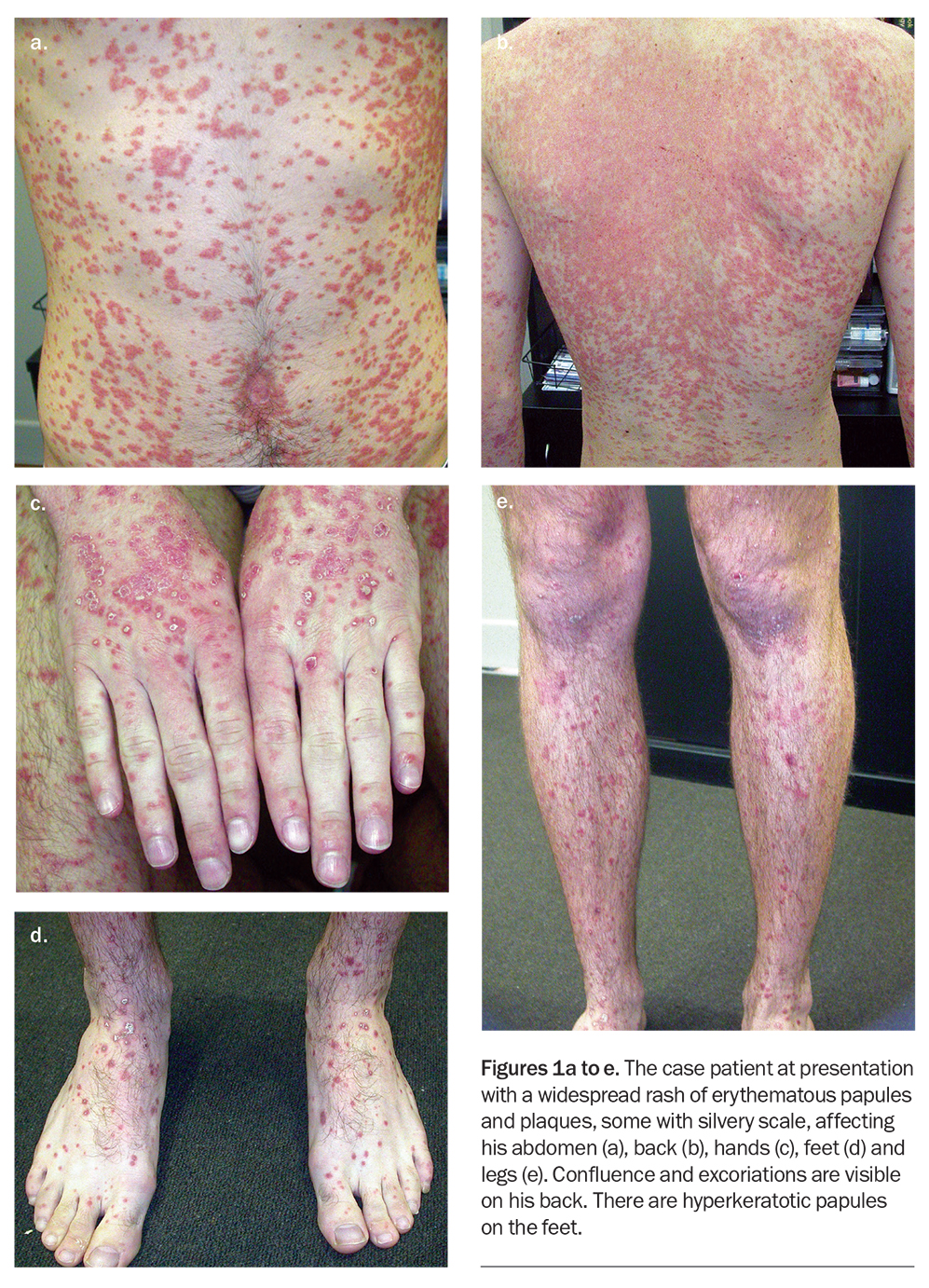 Pityriasis Rosea Herald Patch On Leg